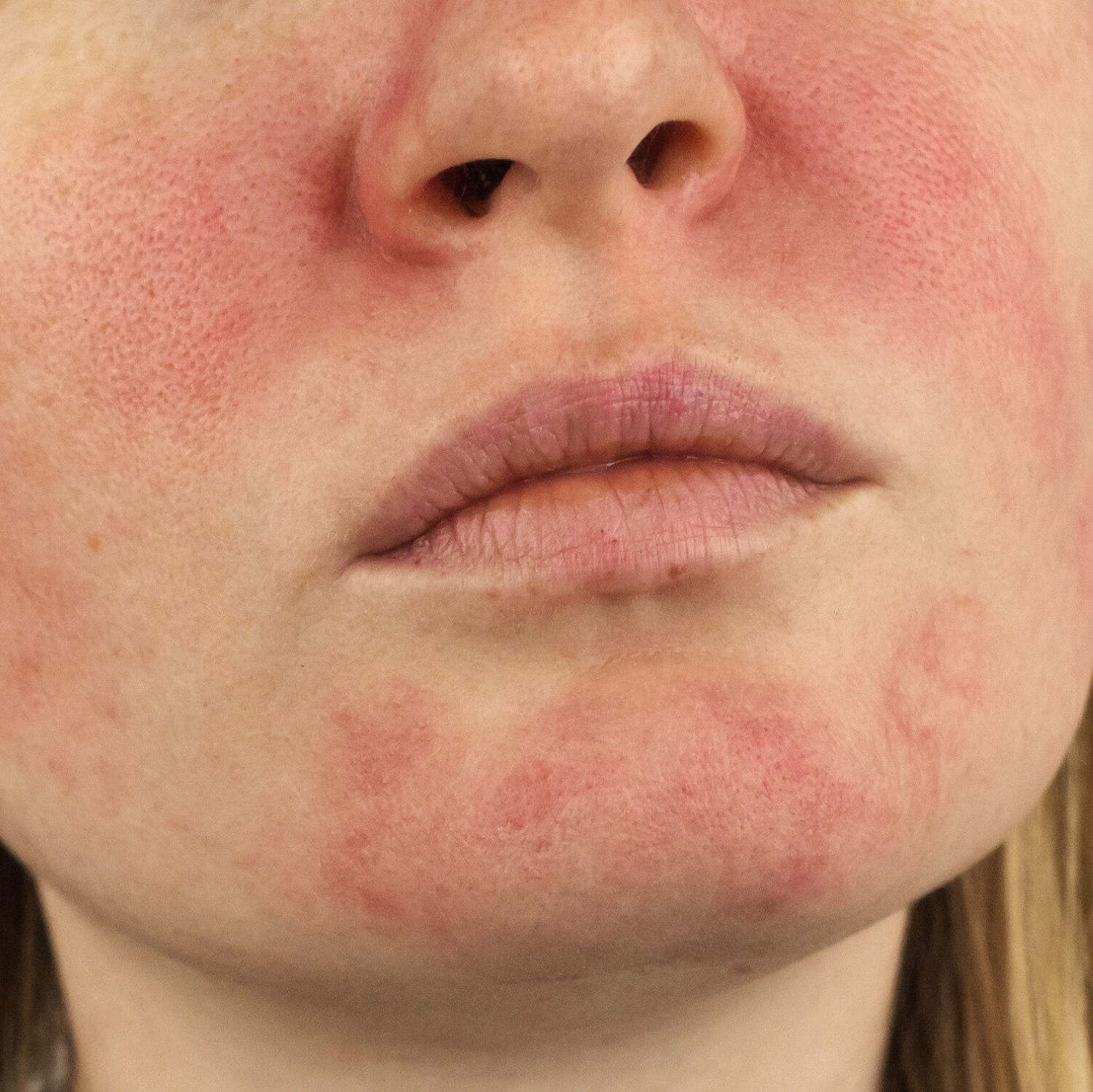 Rosacea