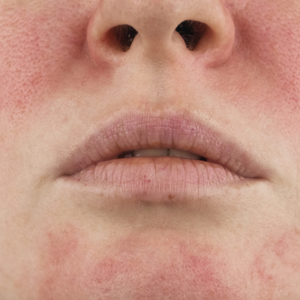 Rosacea