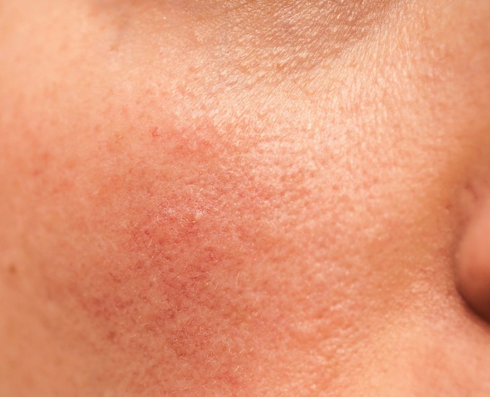 Rosacea Solution Bundel