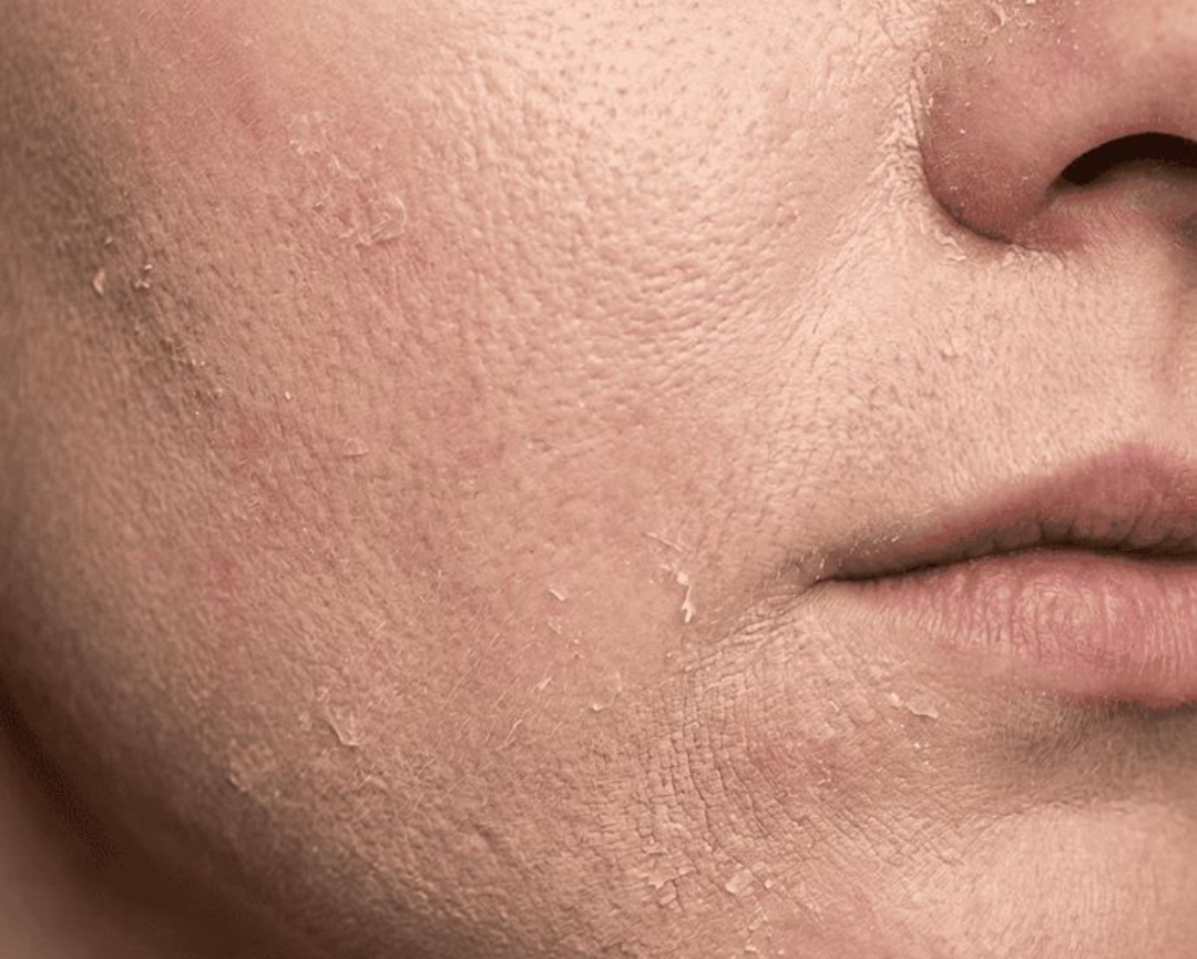 Droge huid Regimen Set