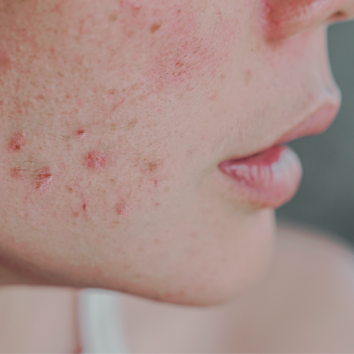 natural solutions for Acne skin
