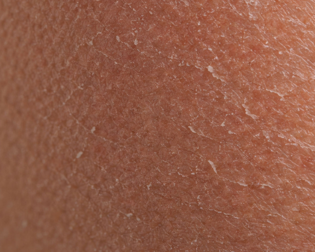 Droge Huid Solution Bundel 