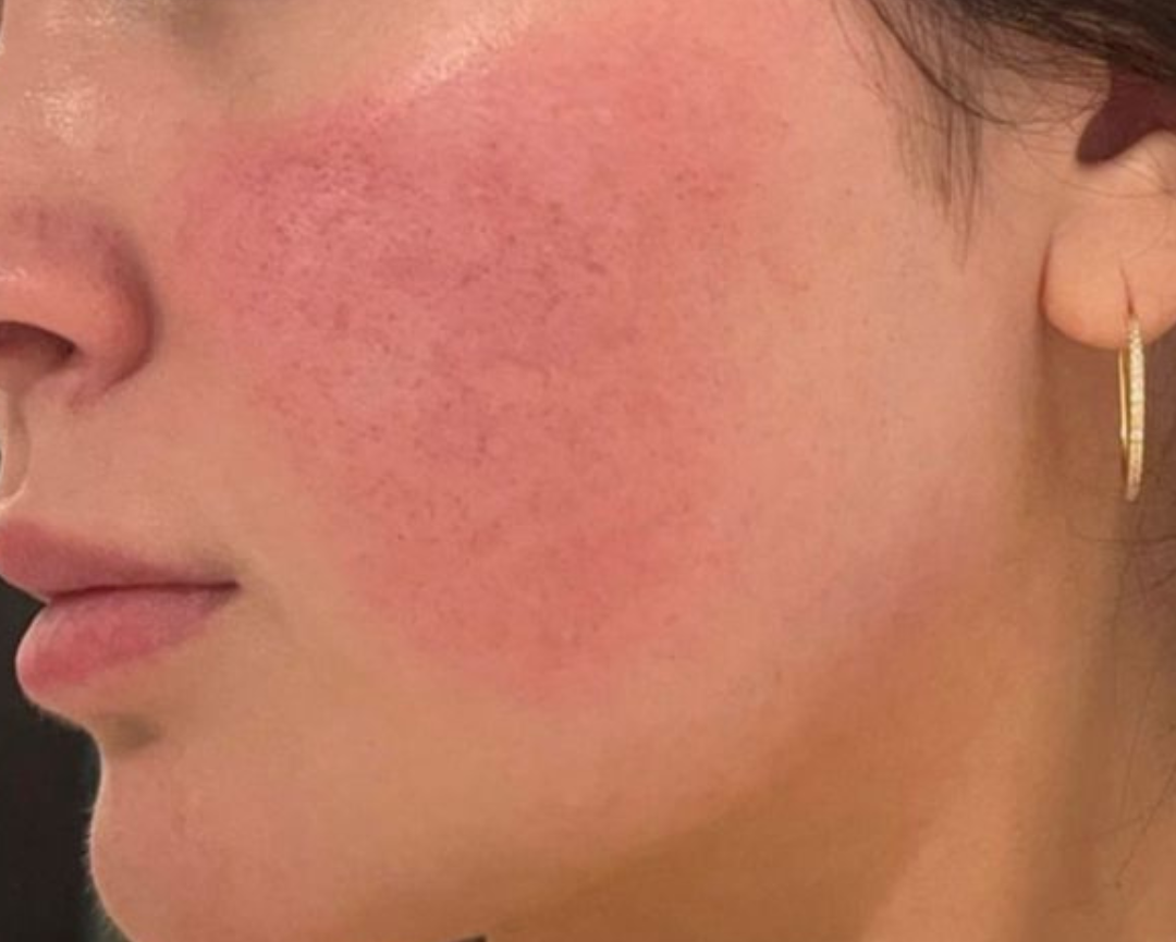 Rosacea Solution Bundel